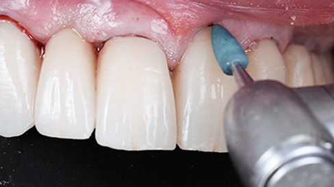 Saubere Restaurationsränder nach der Politur